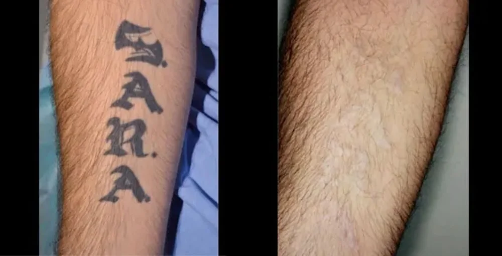 Laser Tattoo Removal before and after, enlarged: the same person before treatment on the left and after treatment on the right, case 1. Results may vary.