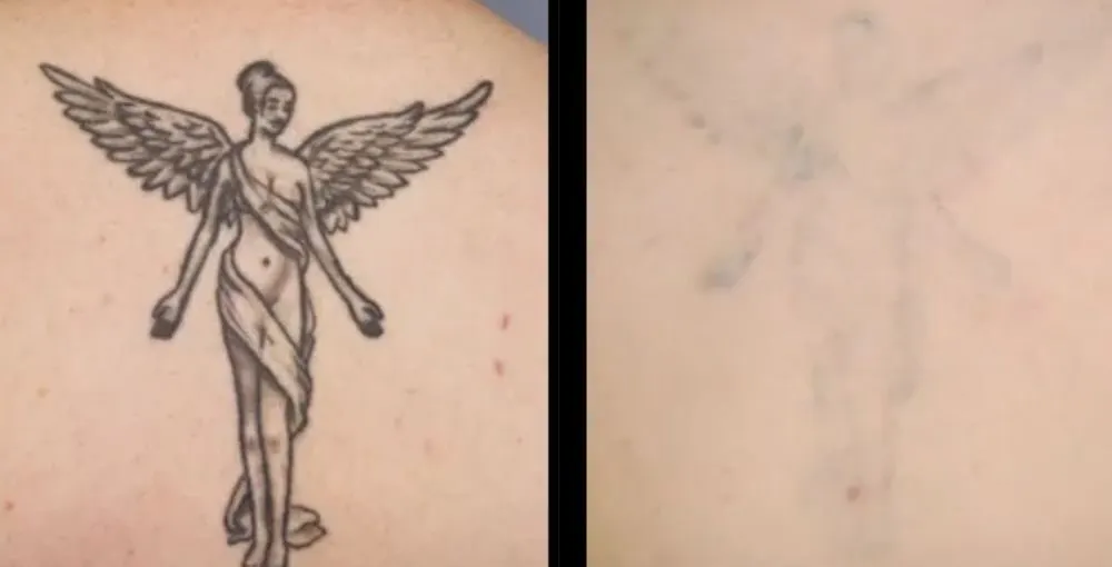 Laser Tattoo Removal before and after: the same person before treatment on the left and after treatment on the right, case 2. Results may vary.