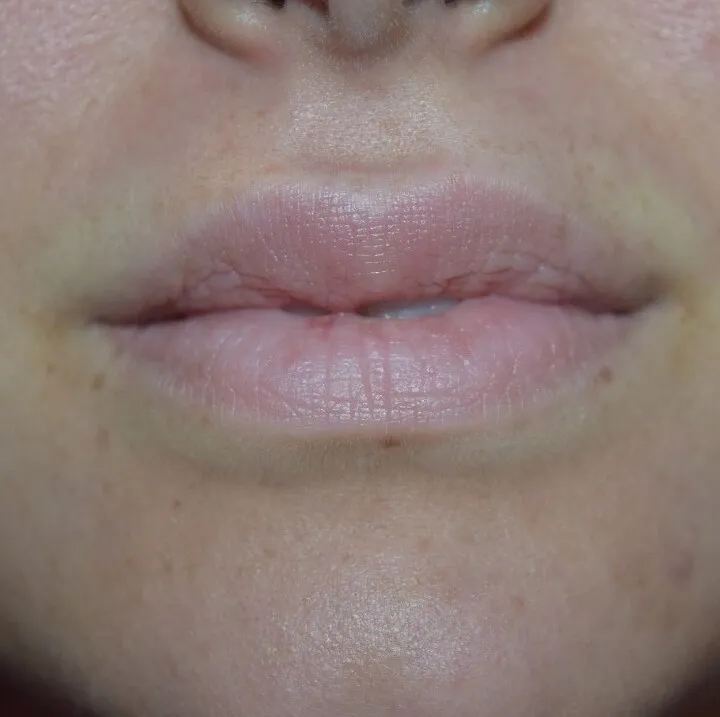 Front view of a mouth before LipLase, the lips pale and flat with fine vertical lines running through them