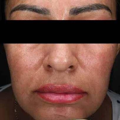 The same lower face after Moxi, with the patching lightened and the tone more even