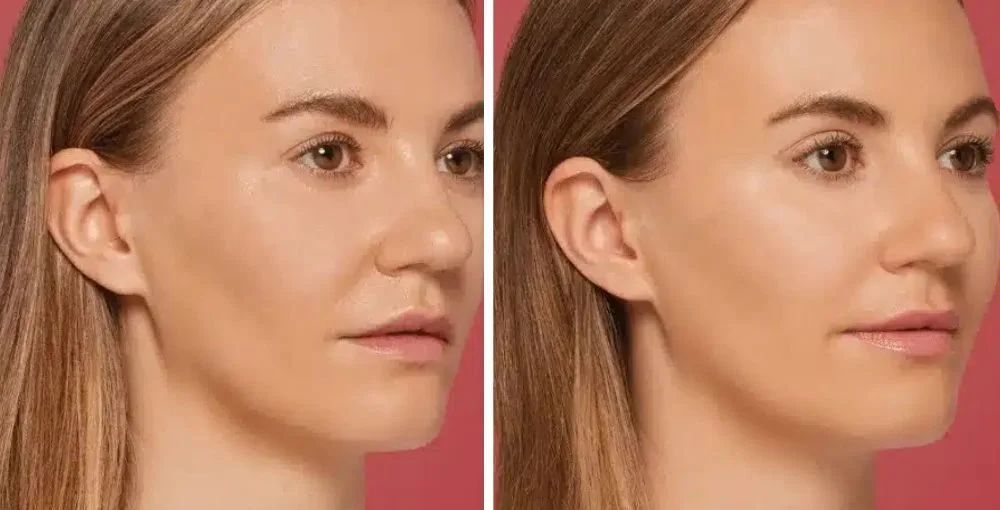 Restylane before and after, enlarged: the same person before treatment on the left and after treatment on the right, case 3. Results may vary.