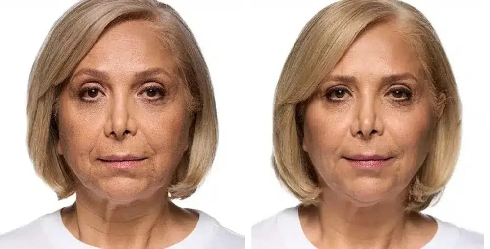 Revanesse (Versa) before and after, enlarged: the same person before treatment on the left and after treatment on the right, case 2. Results may vary.