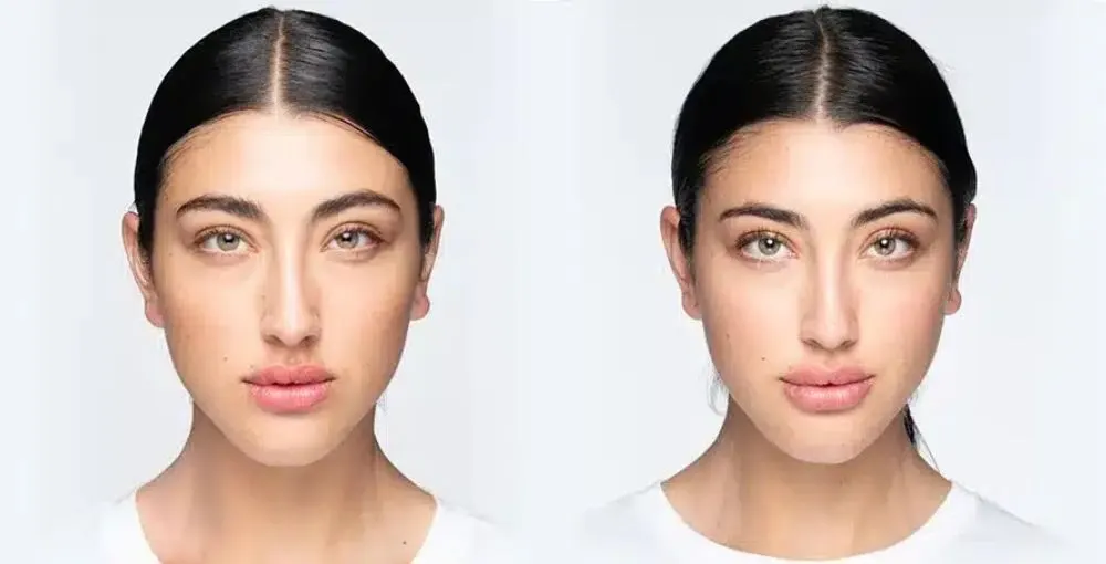 Revanesse (Versa) before and after: the same person before treatment on the left and after treatment on the right, case 5. Results may vary.