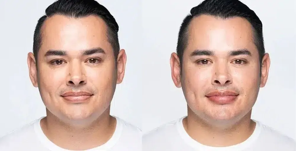 Revanesse (Versa) before and after: the same person before treatment on the left and after treatment on the right, case 6. Results may vary.