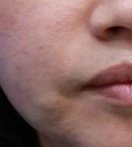 The same lower face after RF microneedling, with the cheek texture smoother and the tone more even