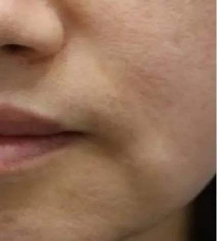 Front view of a woman’s lower face before RF microneedling, showing uneven texture and shallow depressions across the cheek