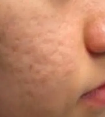 Close view of a cheek beside the nose before RF microneedling, showing dense pitted scarring across the cheek