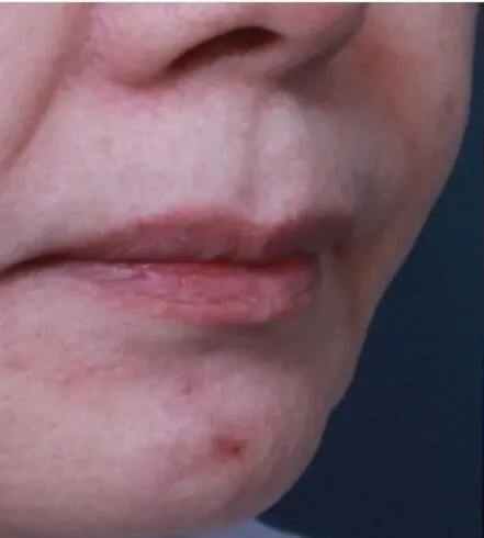 Close view of a chin and mouth before RF microneedling, showing two raised inflamed spots on the chin with uneven skin around them