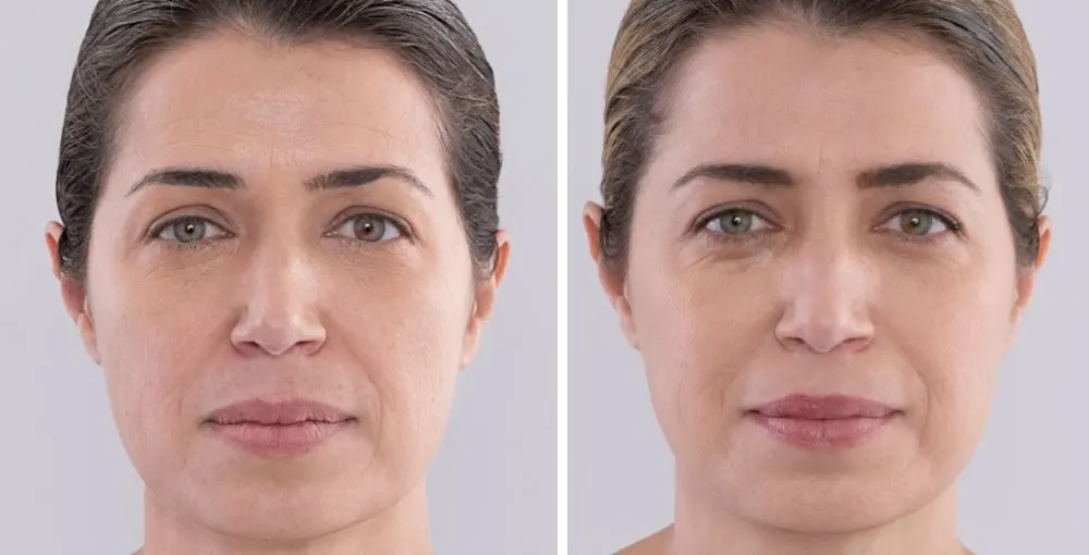 Sculptra before and after: the same person before treatment on the left and after treatment on the right, case 1. Results may vary.