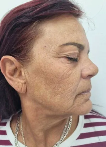 Three-quarter view of a woman before laser resurfacing, showing brown sun mottling across the cheek and crepey texture along the jaw