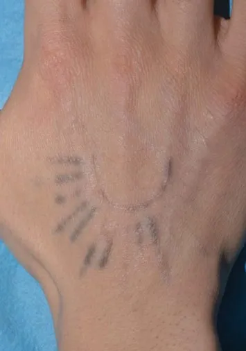 The same hand after laser tattoo removal, with the design reduced to a faint grey outline