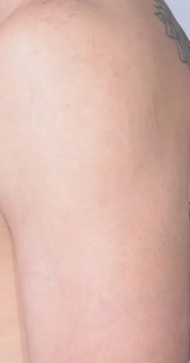 The same upper arm after laser tattoo removal, with the piece cleared and the skin even