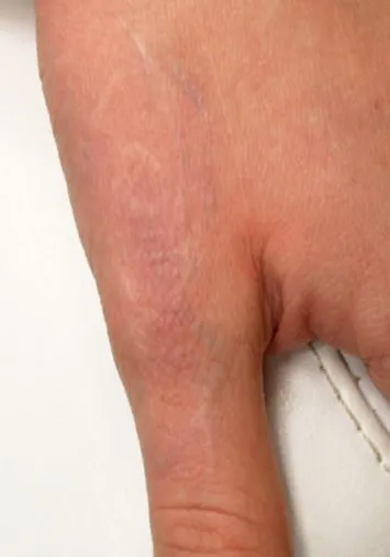 The same hand after laser tattoo removal, with only faint pink shadowing where the spider was