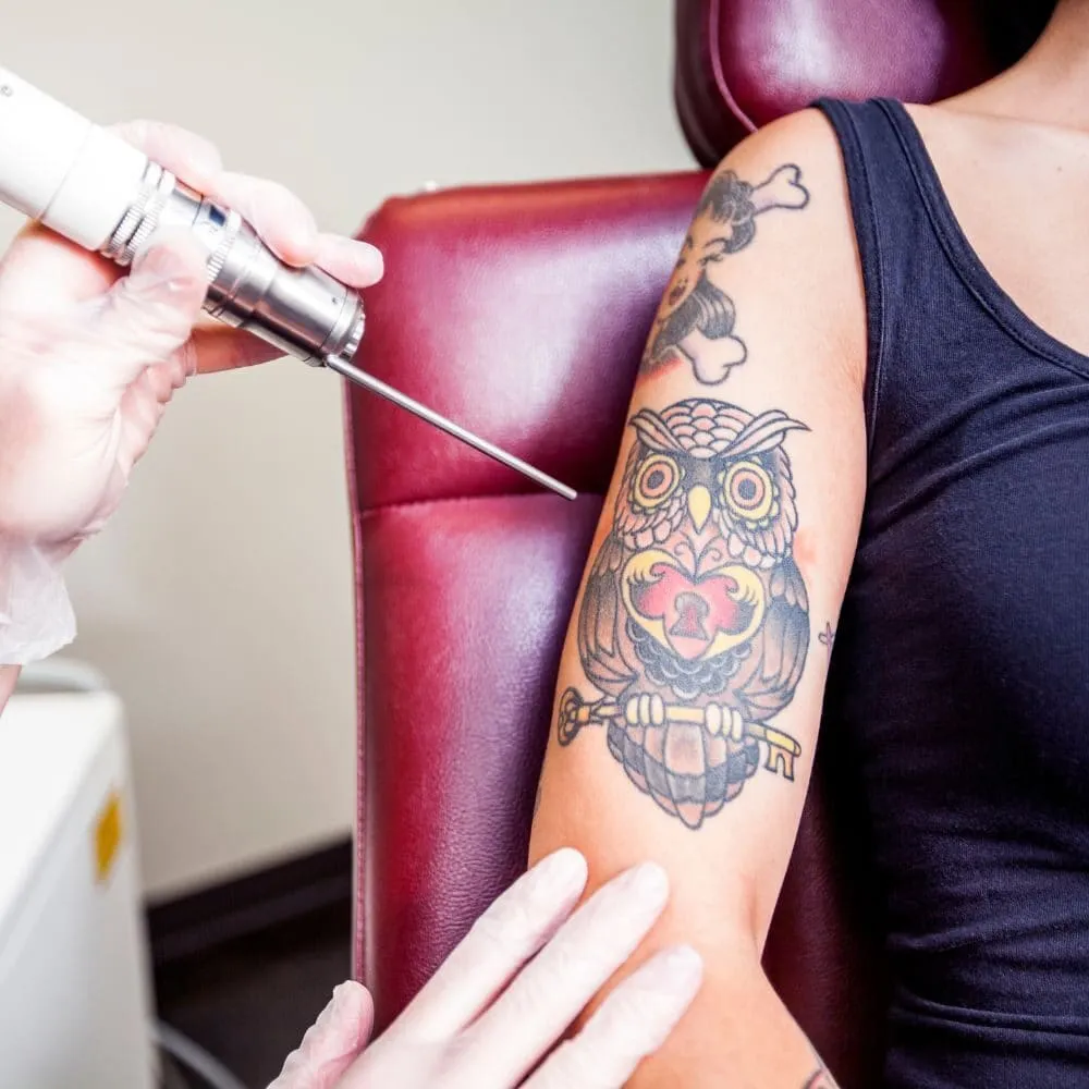 Gloved hand guiding a laser handpiece over a coloured owl tattoo on a patient's upper arm, resting against a dark red treatment chair