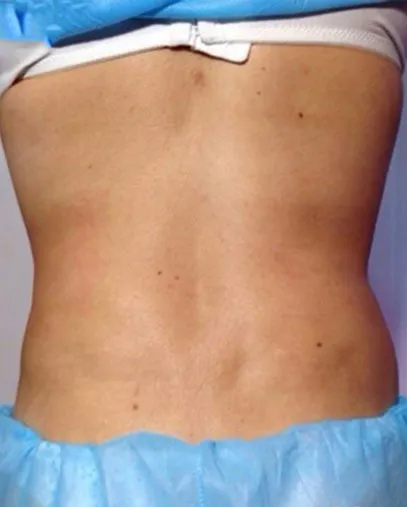 The same back view after TightSculpting, with the flanks smoother and the waistline cleaner