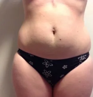 Front view of a woman’s abdomen and hips before TightSculpting, showing fullness around the waist and hips