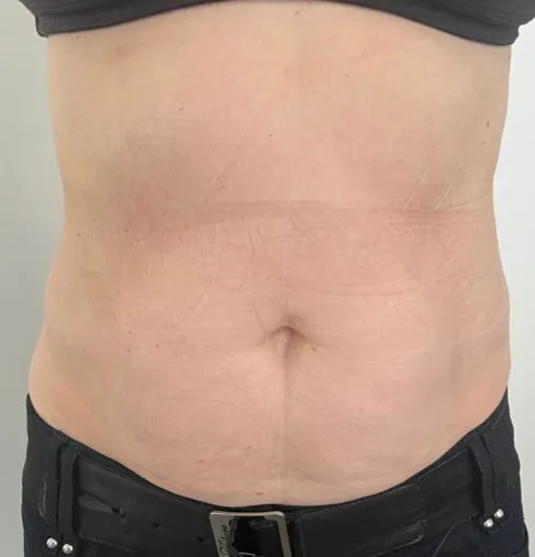The same front view after TightSculpting, with the lower abdomen flatter