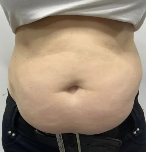 Front view of a woman’s abdomen before TightSculpting, showing a fuller lower belly over the waistband