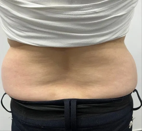 Back view of a woman’s lower back before TightSculpting, showing a roll above the waistband