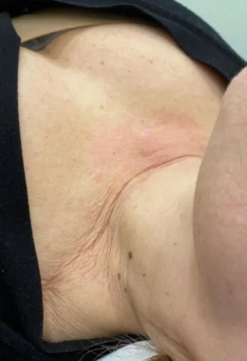 Close-up of an underarm and inner upper arm before TightSculpting, showing crepey lax skin