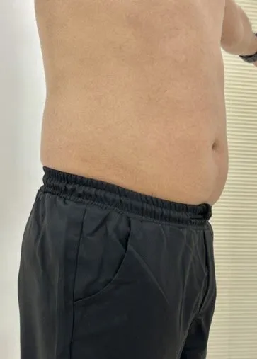 Side view of a man’s abdomen before TightSculpting, showing fullness above the waistband