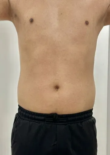 Front view of a man’s abdomen before TightSculpting, showing softness either side of the navel