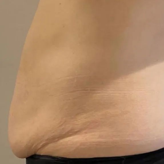 Side view of a hip and flank before TightSculpting, showing soft fullness carried down from the waist