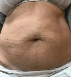 Close-up of an abdomen before TightSculpting, showing soft slack skin either side of the navel