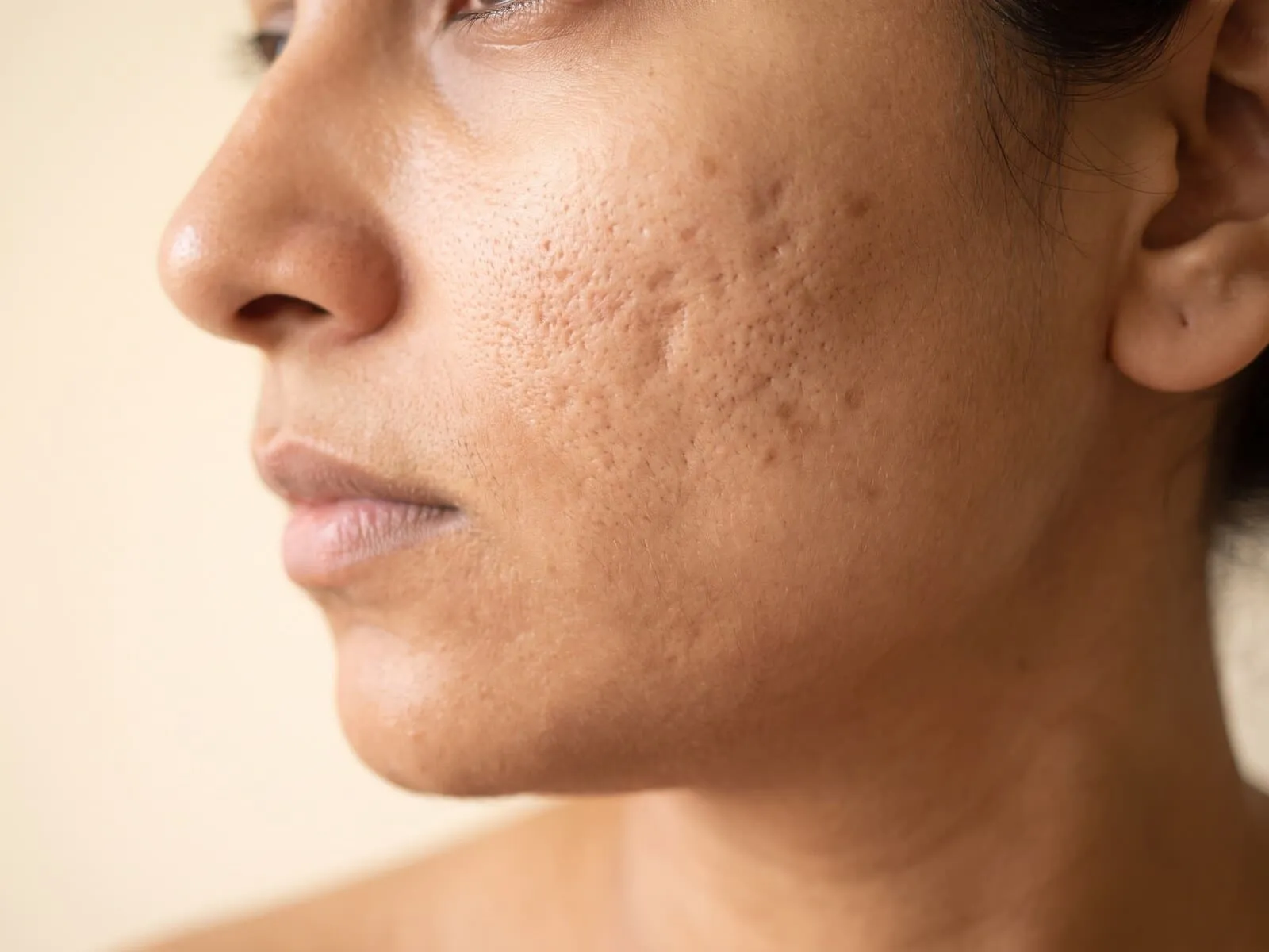 Close-up of a cheek with indented acne scarring and visible texture, the kind of concern microneedling with PRP or PRF is used for