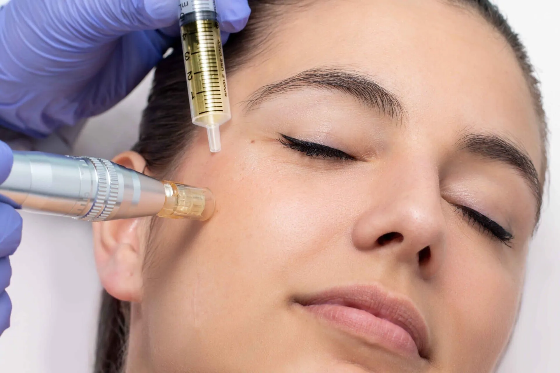 A microneedling pen held against a patient's cheek beside a syringe of golden platelet concentrate drawn from her own blood