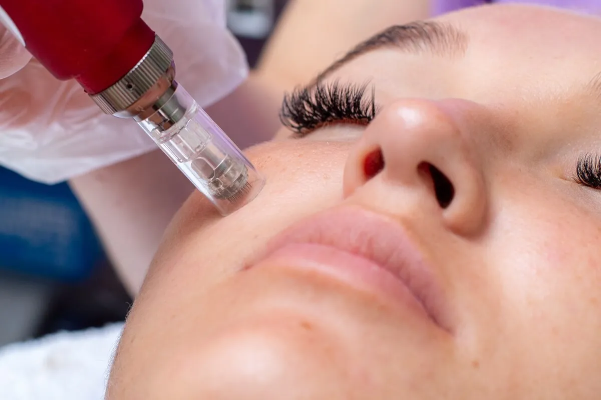 A microneedling pen cartridge held against a patient’s cheek during a SkinPen session, needles alone with no serum added
