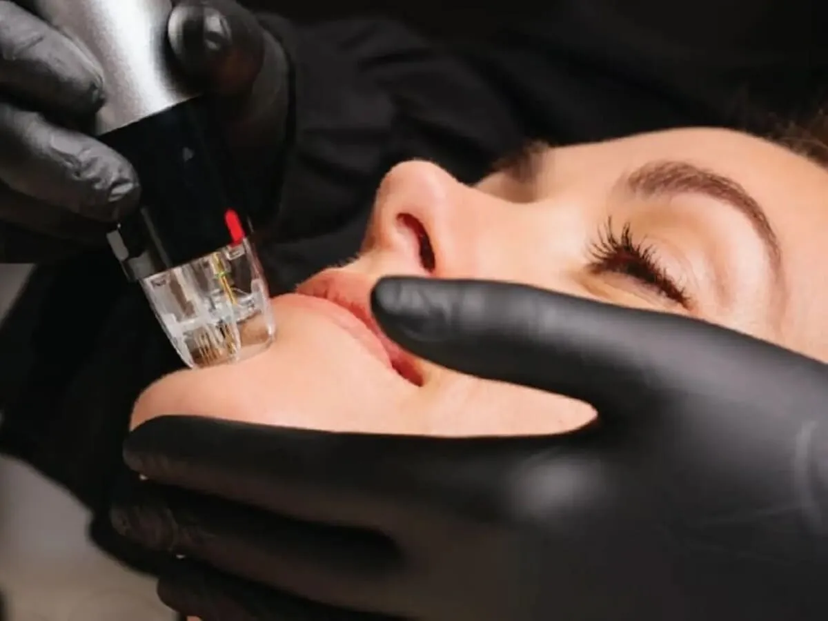 Gloved clinician holding an RF microneedling handpiece with its needle cartridge against the cheek of a reclining patient, her jaw steadied by the free hand