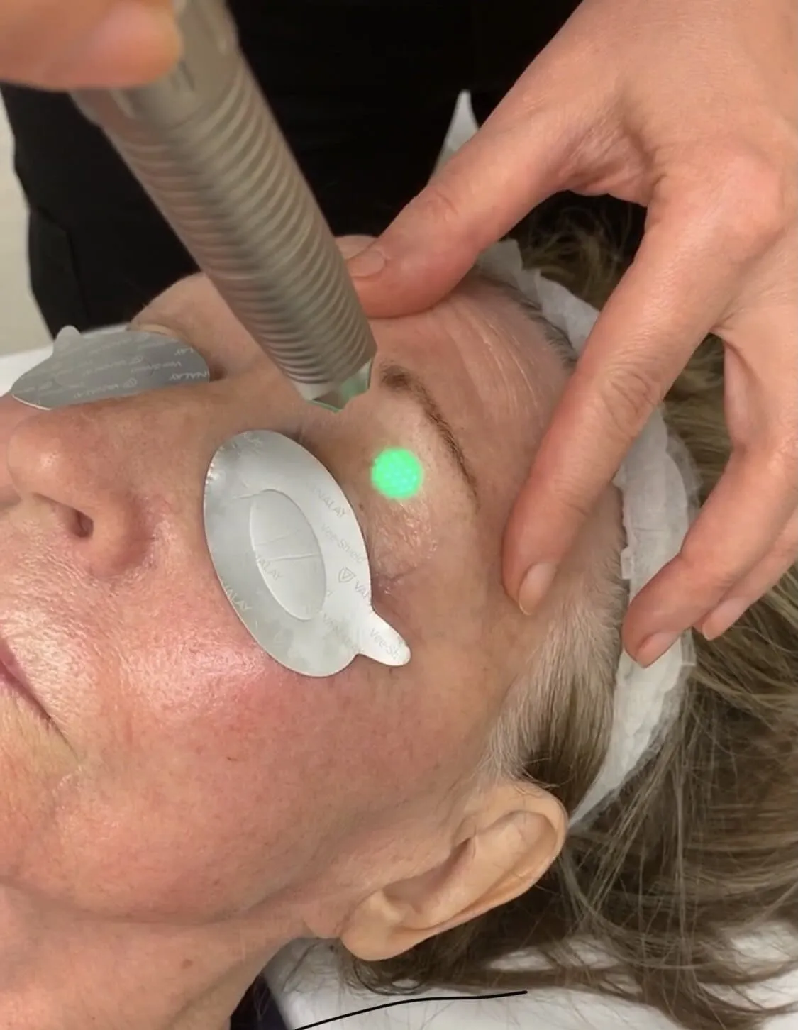 A laser handpiece held against the brow of a patient wearing taped protective eye shields during a SmoothEye session at Medrein Health